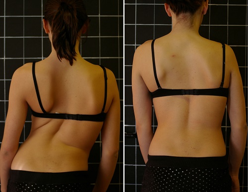 Severe Scoliosis Before and After Treatment